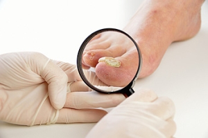 How to Treat Toenail Fungus