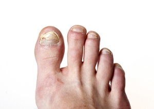 How Do I Know If I Have Toenail Fungus?