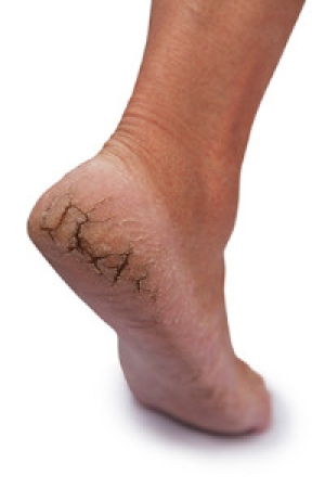 Caring for Cracked Heels